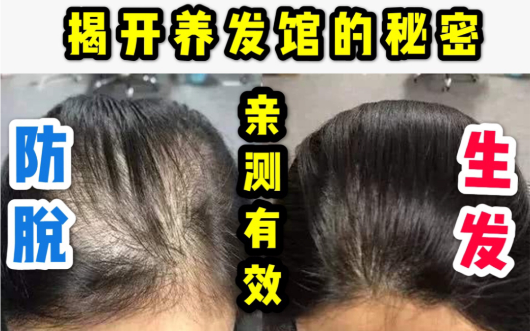 揭秘养发馆最简单有效防脱生发教程丨6年经验总结多人亲测有效丨生发