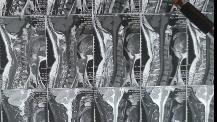 颈椎核磁报告上的T1T2信号减低是什么意思?哔哩哔哩bilibili