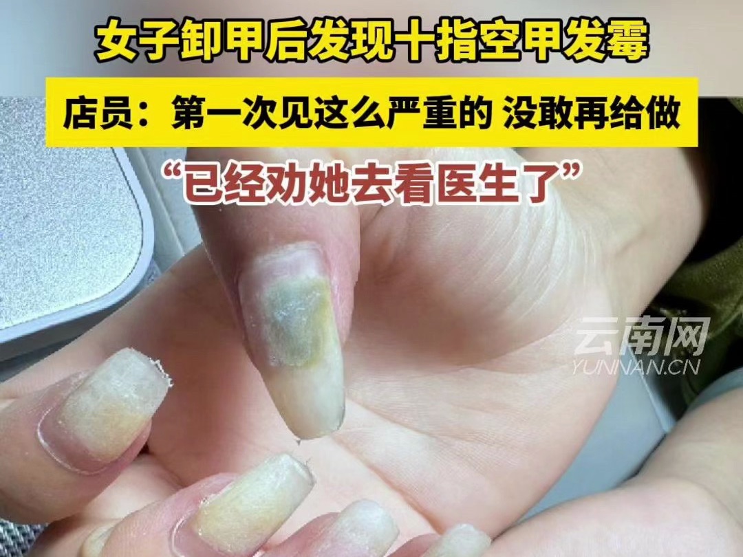 女子卸甲后发现十指空甲发霉 店员:第一次见这么严重的 没敢再给做 已经劝她去看医生了哔哩哔哩bilibili