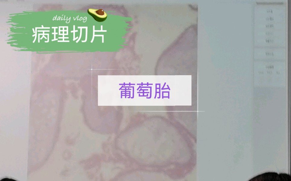 【病理实验切片】葡萄胎哔哩哔哩bilibili