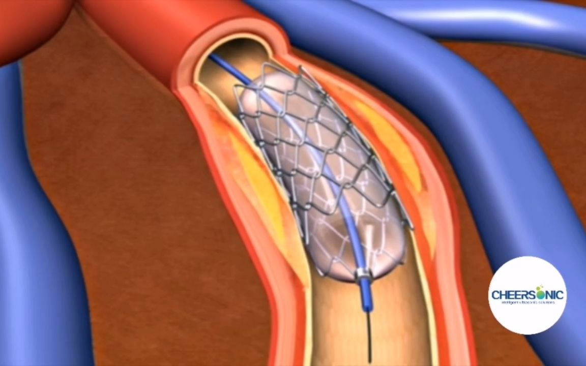 动画演示——冠状动脉支架植入术哔哩哔哩bilibili
