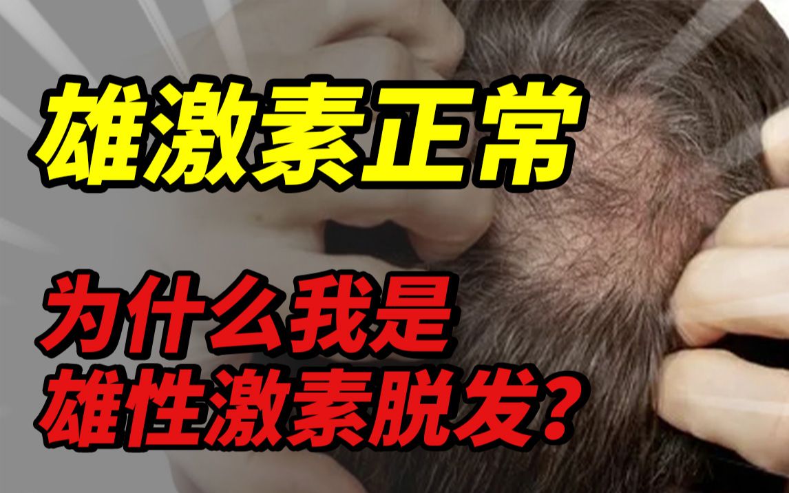 【老宋科普】雄激素正常,为什么还会导致雄性激素脱发?哔哩哔哩bilibili