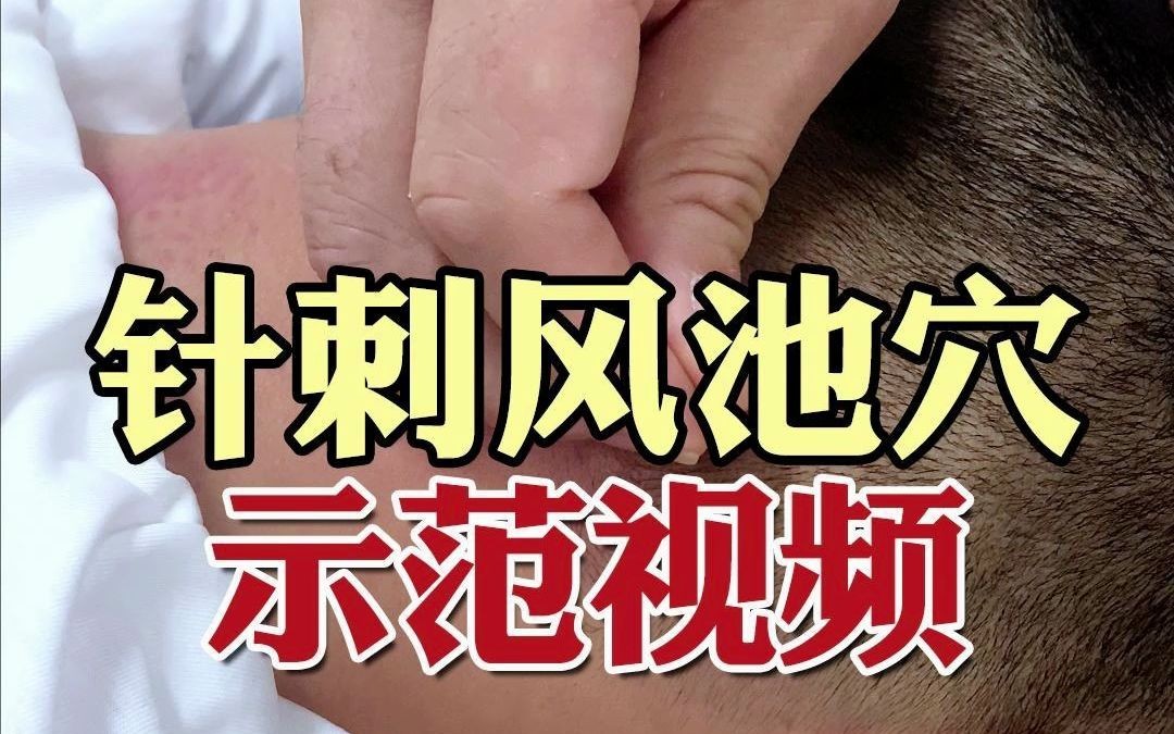 针刺风池穴示范视频