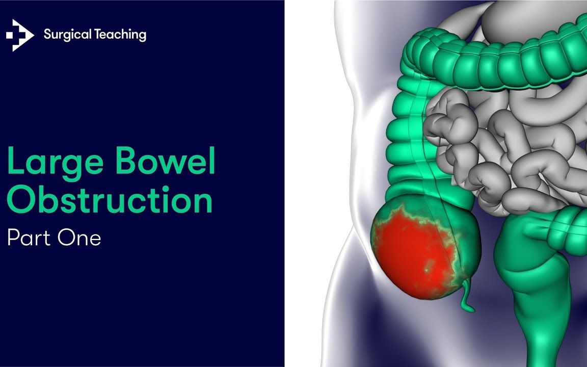 大肠梗阻第一部分 | 什么是大肠梗阻哔哩哔哩bilibili