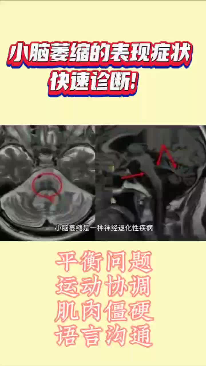 小脑萎缩的表现症状,快速诊断!哔哩哔哩bilibili