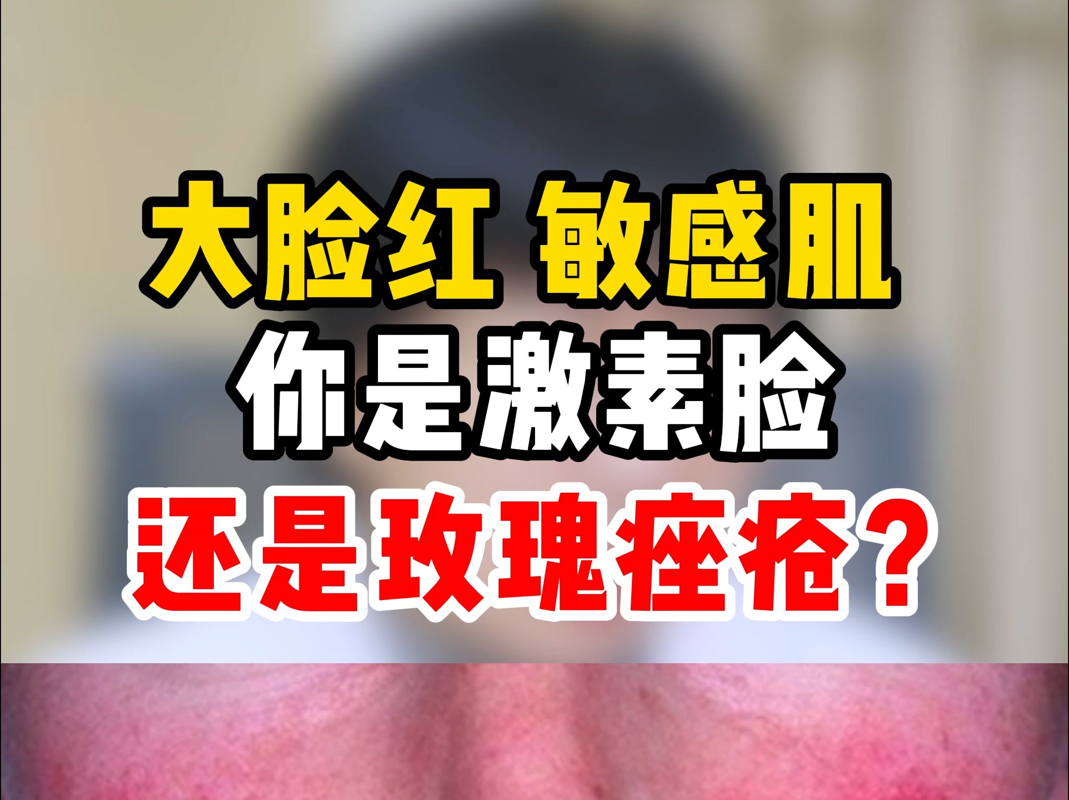 大脸红 敏感肌 你是激素脸还是玫瑰痤疮?