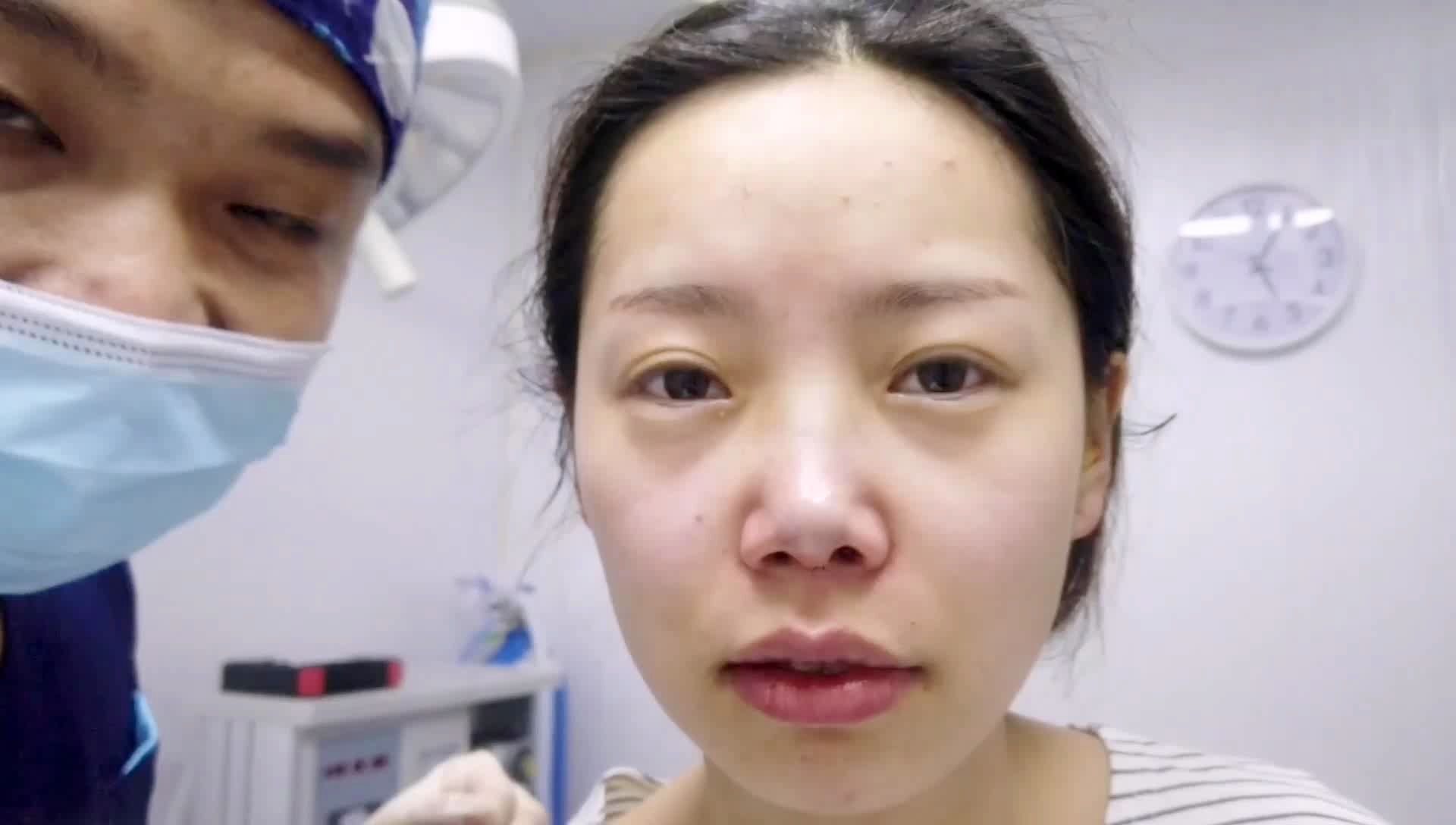 活动  鼻尖有点塌 鼻背宽 鼻基底凹陷一起解决术后即刻效果