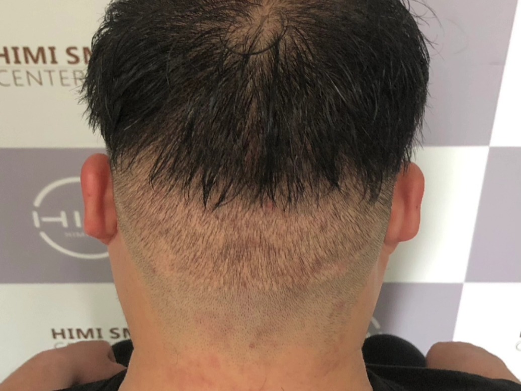 植发好还是纹发好?