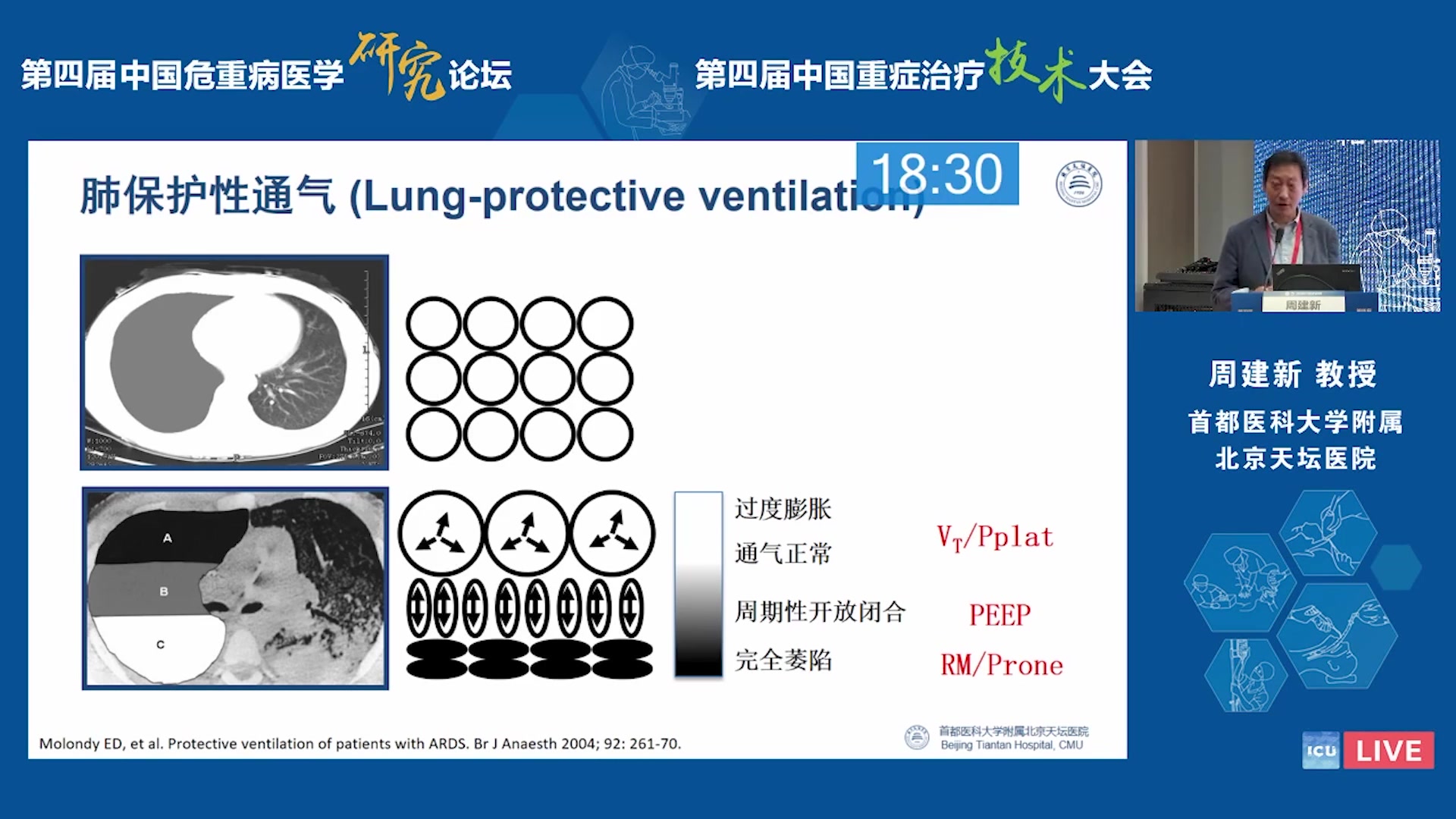 ARDS患者的PEEP设定 周建新 首都医学大学附属北京天坛医院哔哩哔哩bilibili