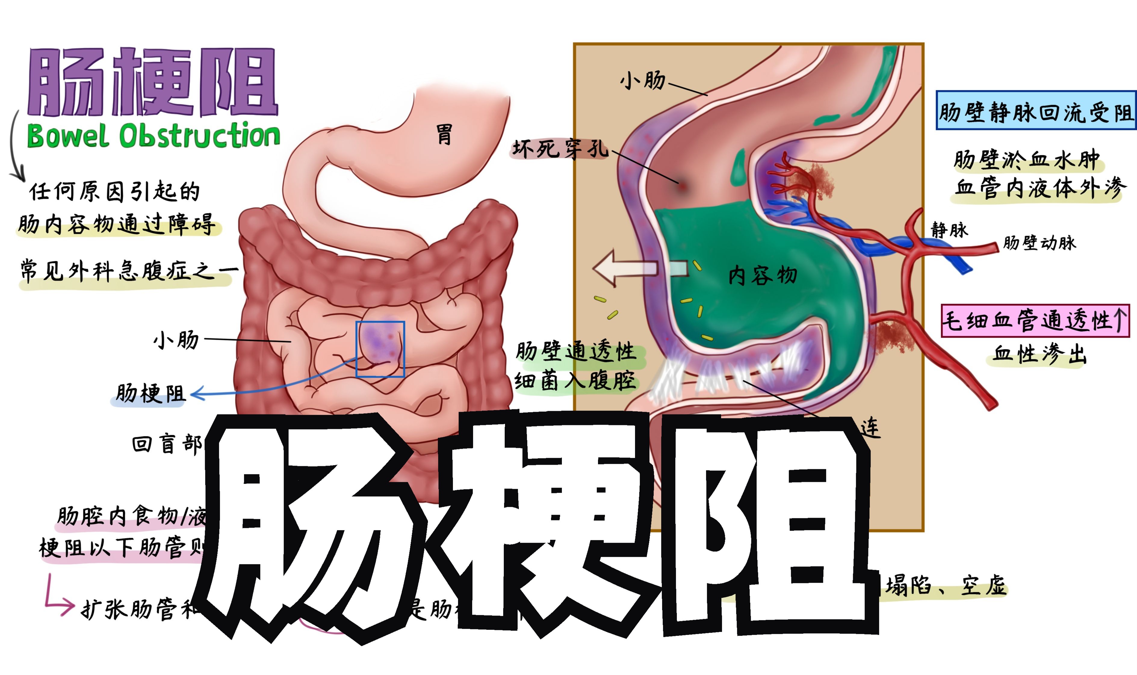 肠梗阻思维导图图片