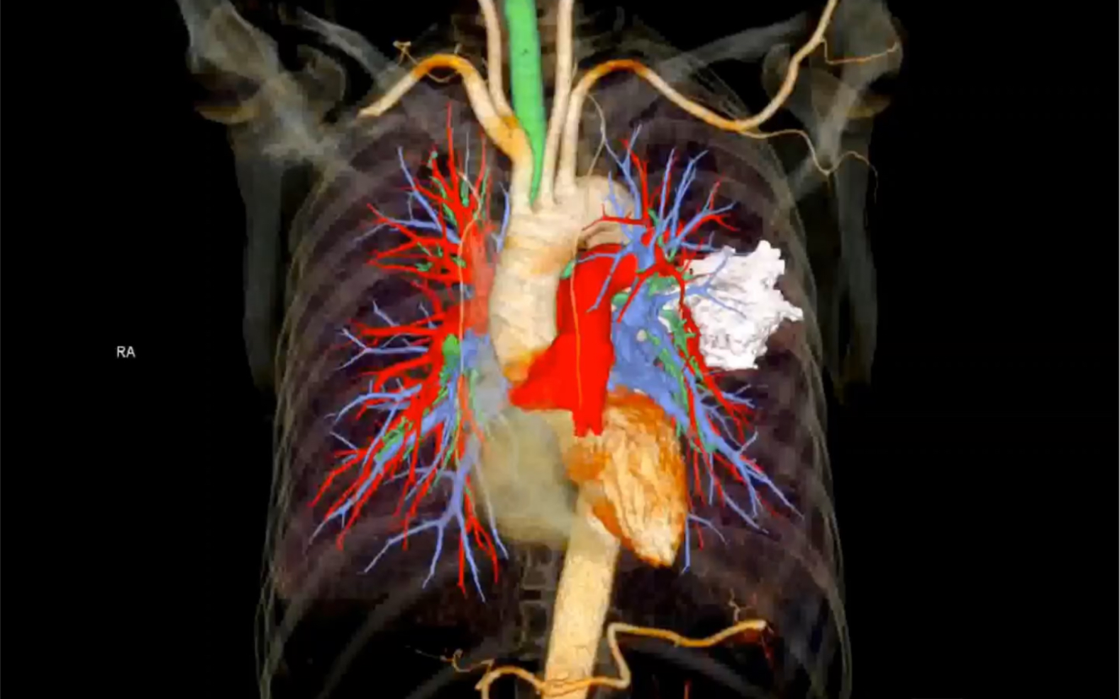 肺肿瘤与周围组织的关系
