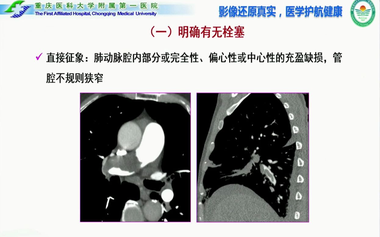 15.肺动脉血管成像图像后处理技术规范及临床应用CT、MRI图像后处理系列1哔哩哔哩bilibili