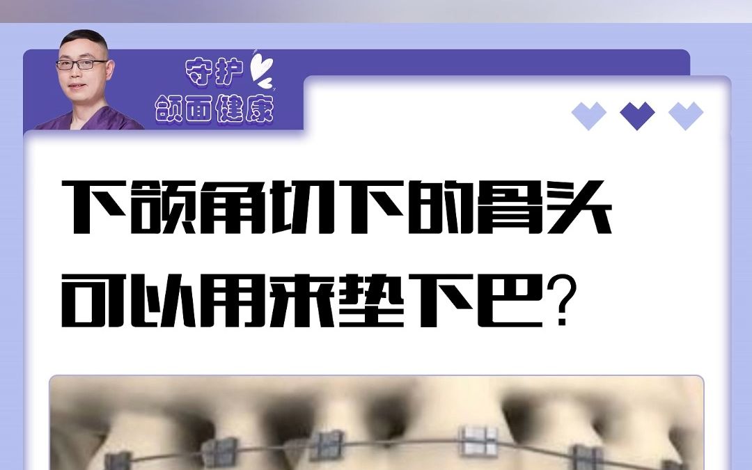 【重庆肖林】下颌角磨骨切下的骨头,可以用来垫下巴?哔哩哔哩bilibili