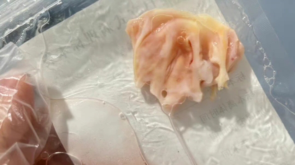 钙化的二尖瓣置换生物瓣