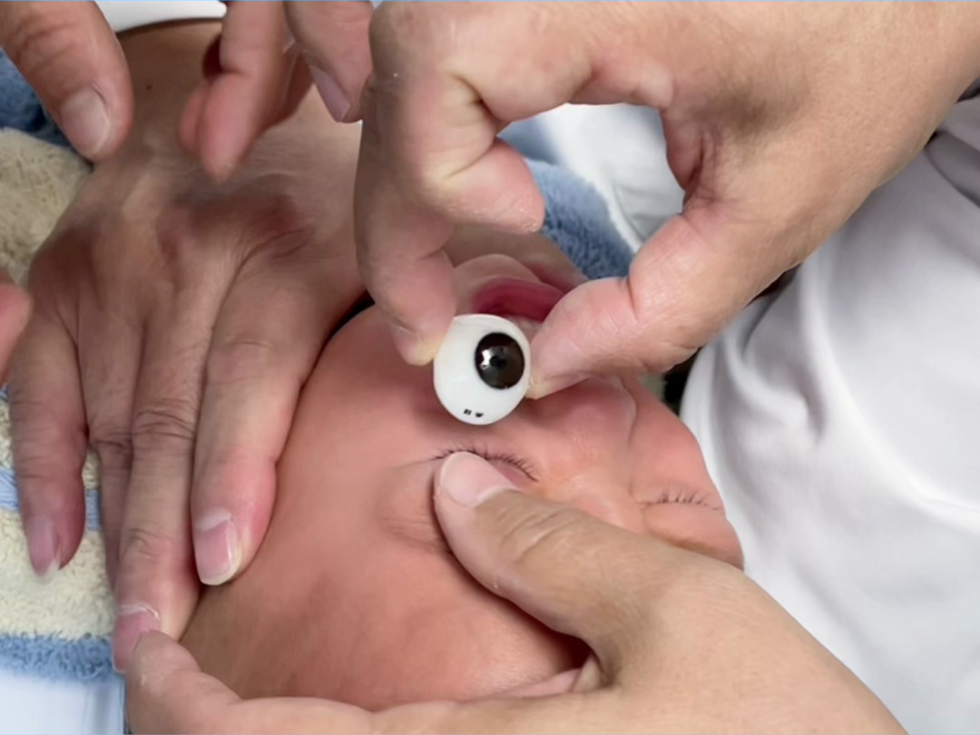 左眼被姐姐扎伤,1岁宝宝首次戴义眼