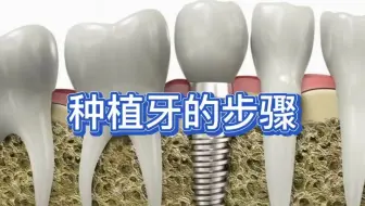 种植牙的步骤：为何种植一个牙齿要这么繁琐，种植周期还要这么久