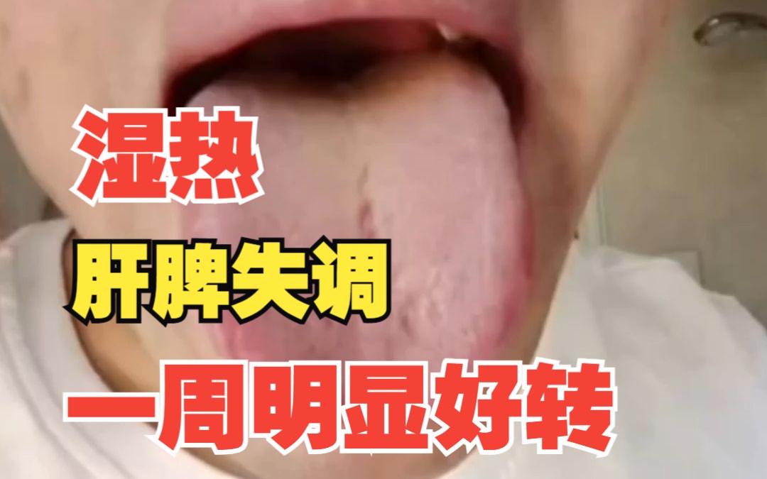 舌诊案例:男士湿热,肝脾失调,一周明显好转哔哩哔哩bilibili