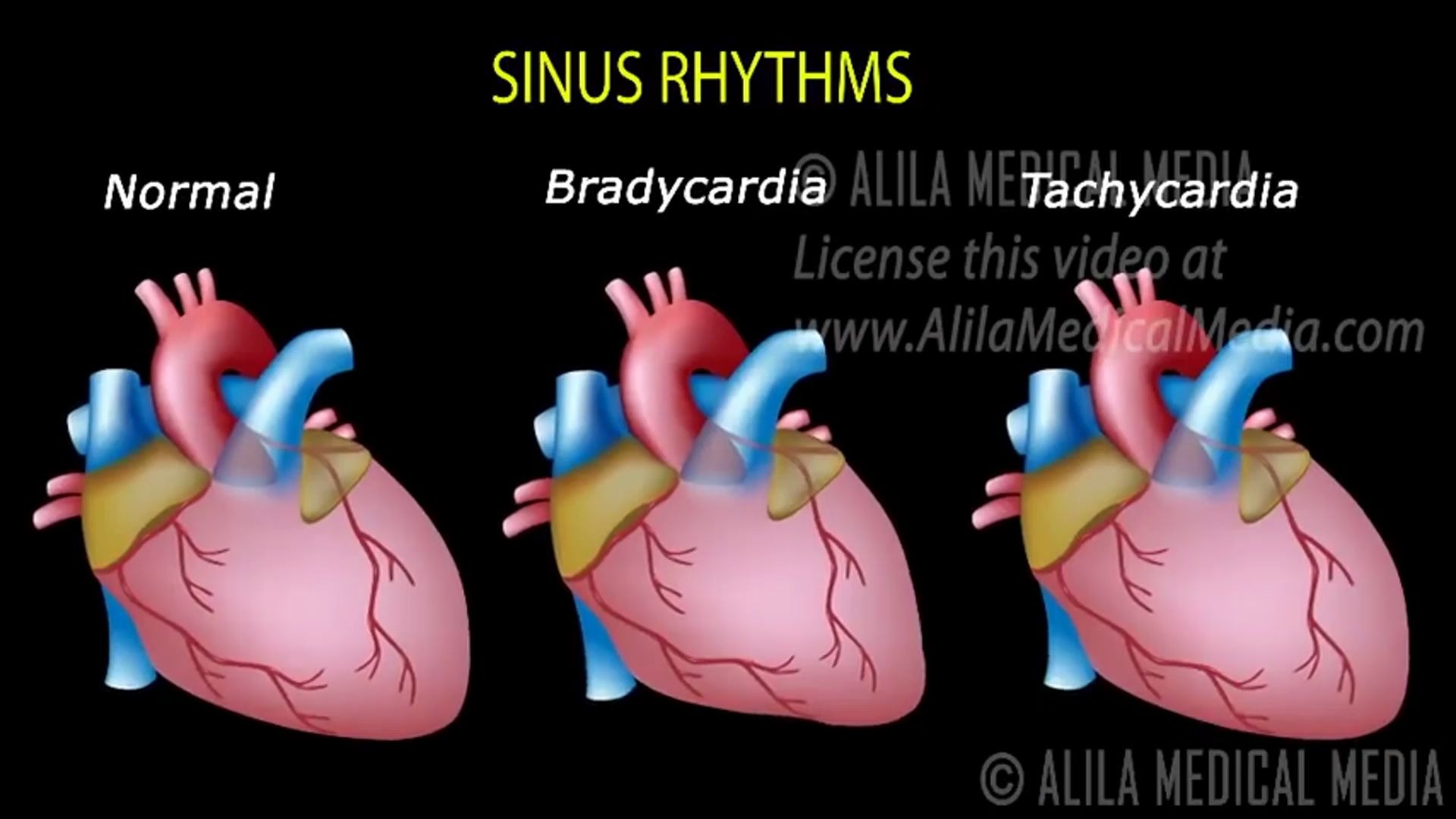 [图]【双语熟肉】心律失常 Cardiac Arrhythmias by AlilaMedicalMedia