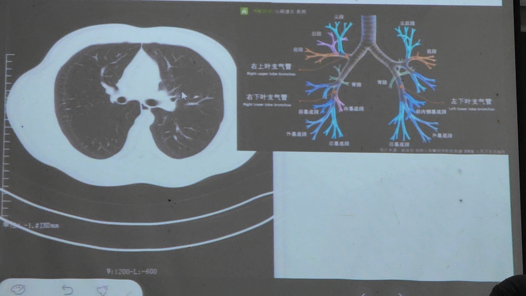 支气管在CT上的分段哔哩哔哩bilibili