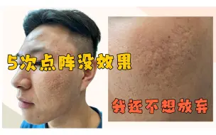 Tải video: 23岁小哥做了5次点阵没有效果，还不想放弃