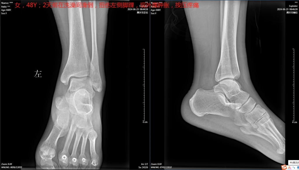医学影像学—DR,扭伤左侧踝关节.X线片检查,影像科医生说无骨折征象,但临床医生坚持说骨折可能性大,要求病人做CT进一步确认.请各位院长、主...