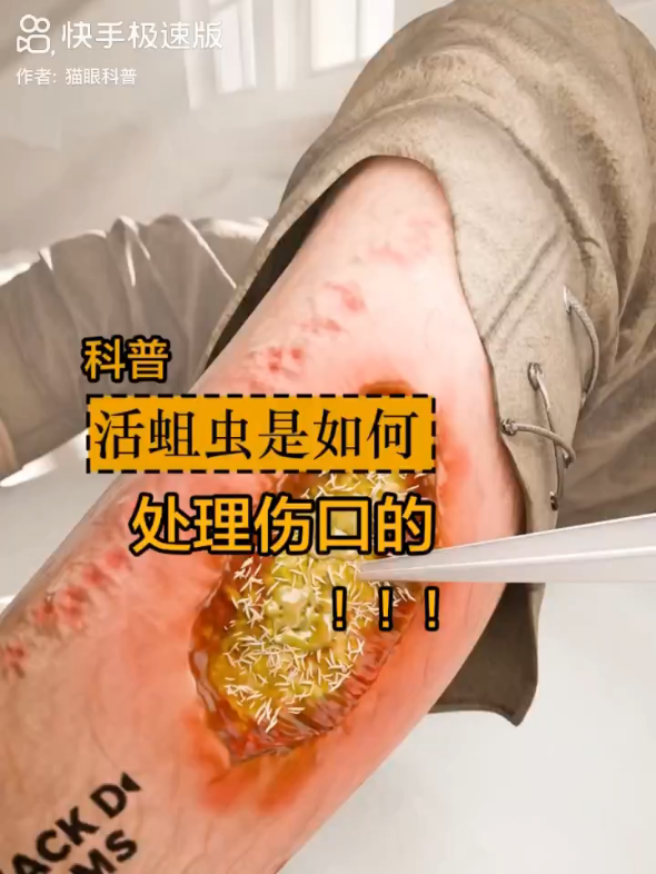 没想到蛆虫他也可以治疗