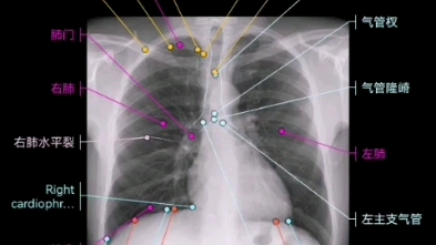 影像解剖图谱 胸片(XRay)+肺部解剖插画哔哩哔哩bilibili