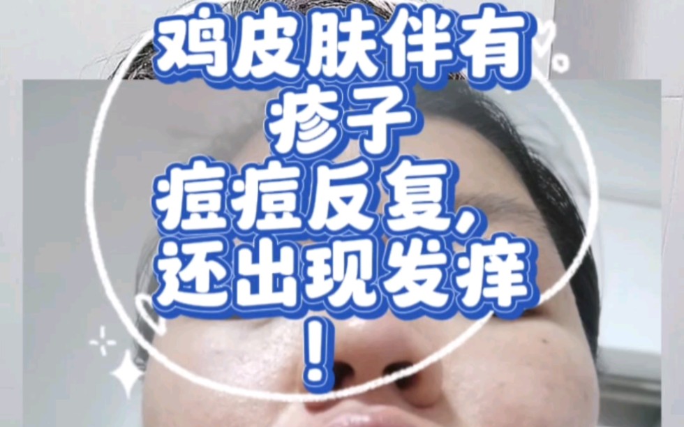 雞皮膚 #疹子痘痘 #皮膚髮癢