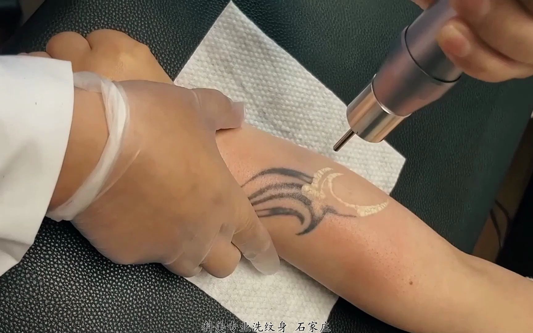 科美专洗难洗别人洗不掉的纹身,不留疤不增生 石家庄洗纹身 #超皮秒洗