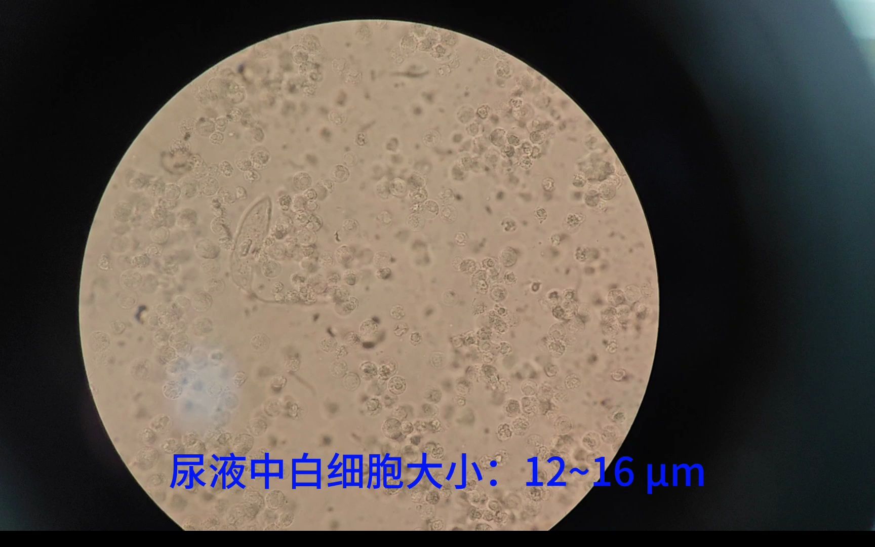尿液中的白细胞(显微镜下)