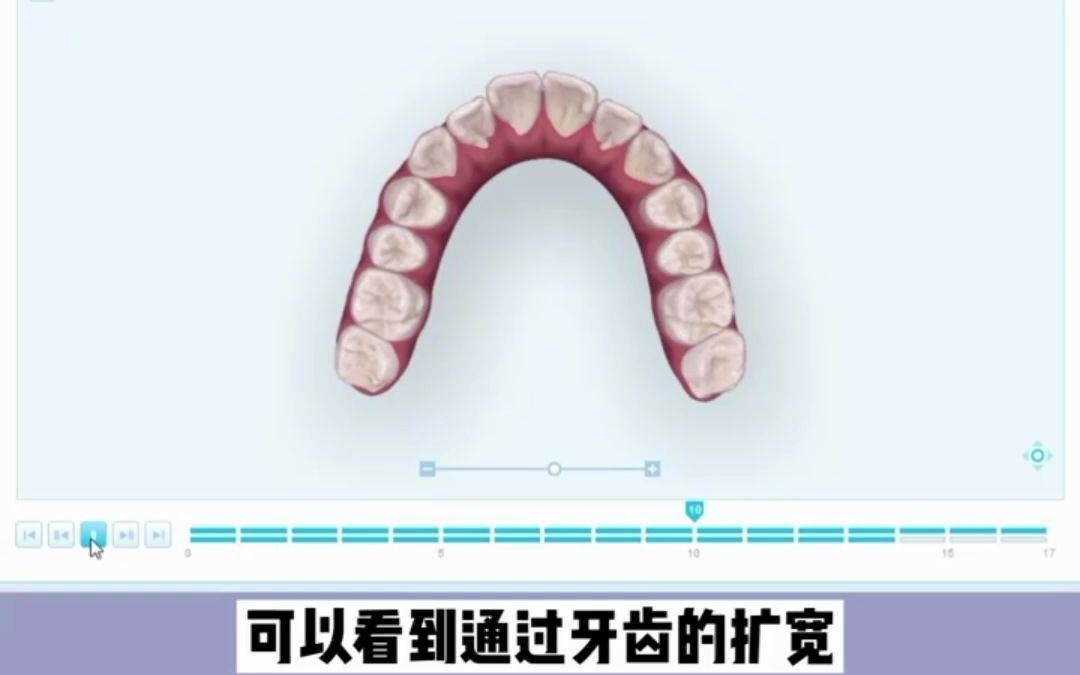 19岁 门牙前突(龅牙) 个别牙反颌|郑州牙齿矫正哔哩哔哩bilibili