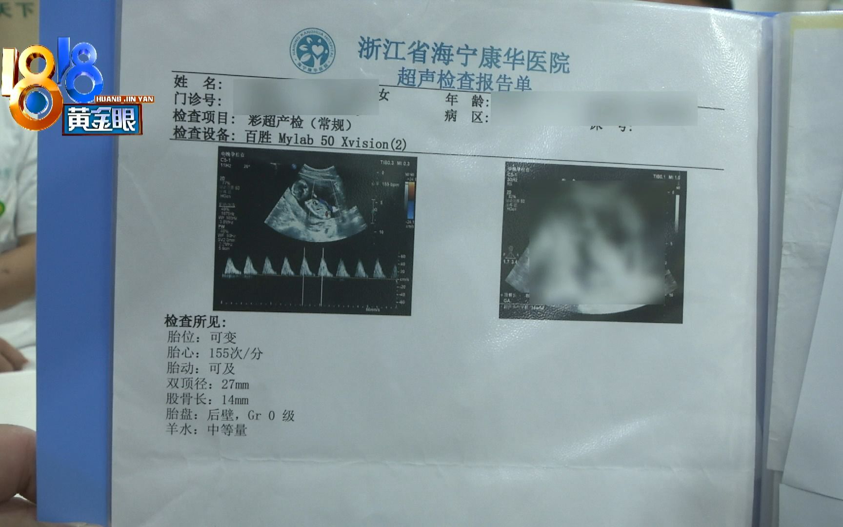 【1818黄金眼】怀孕六个月引产,报告单上少了“关键”的图哔哩哔哩bilibili