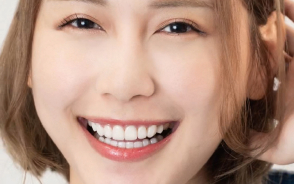 高审美牙齿净白计划前牙美学陶瓷贴片全瓷贴面微笑曲线明星网红同款
