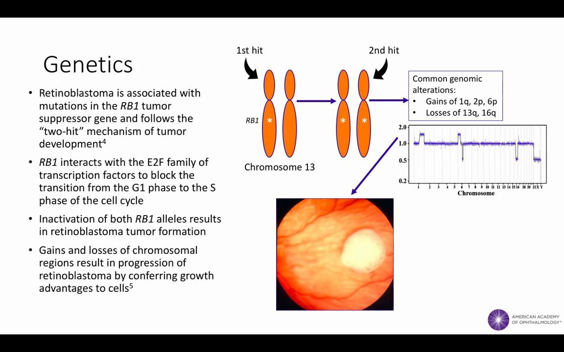 【中英双字】【视网膜母细胞瘤】Retinoblastoma哔哩哔哩bilibili