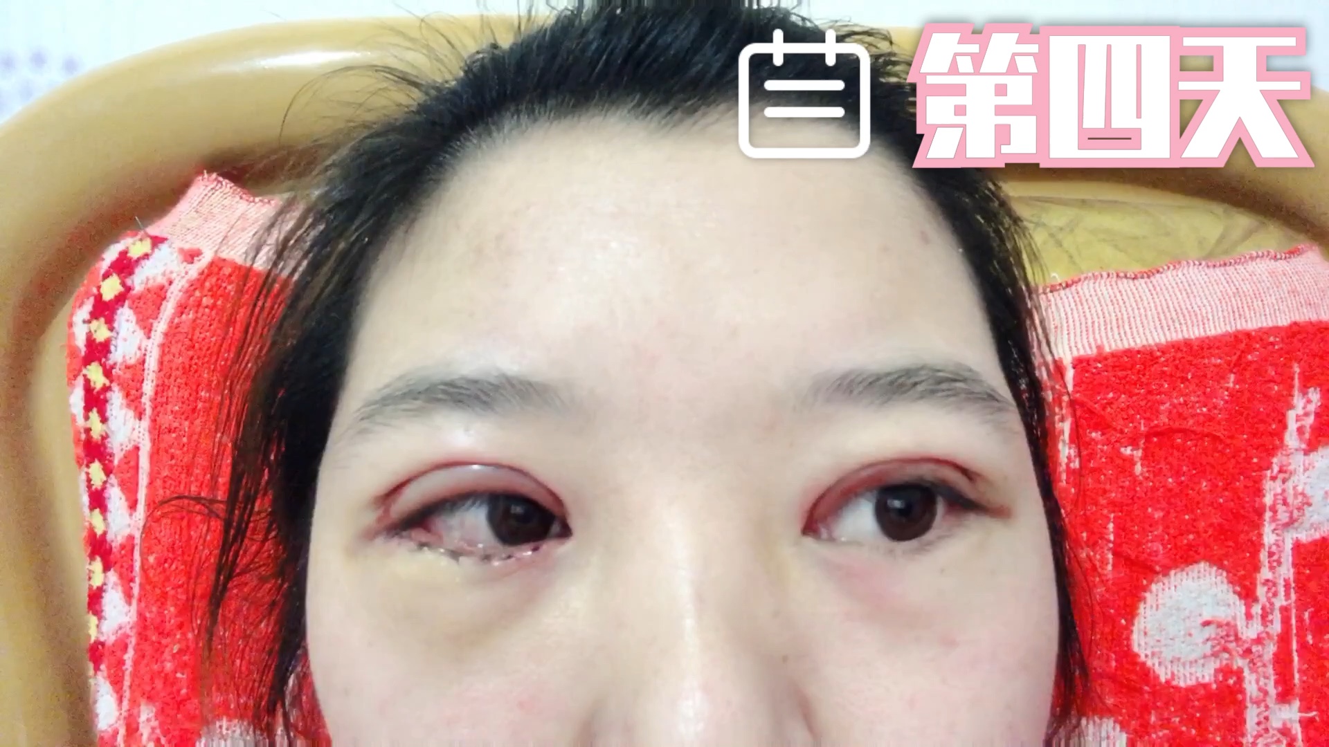 全切双眼皮&提肌&倒睫手术 七天恢复情况_哔哩哔哩 (゜-゜)つロ 干杯