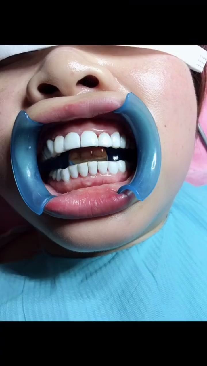 8d纳米浮雕牙_哔哩哔哩 (゜-゜)つロ 干杯~-bilibili