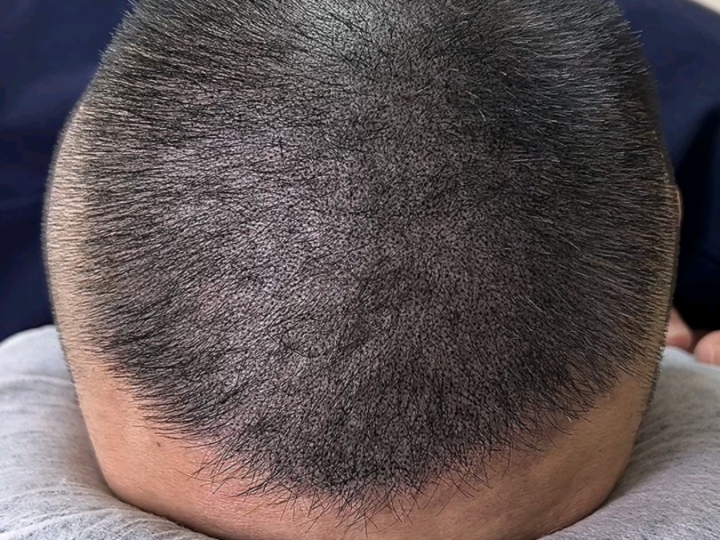 牛老师给榆林的朋友,纹了一个发-陕西纹发西安纹发中心-陕西纹发西安