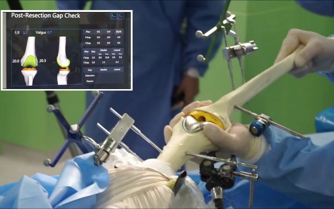 铣削类---膝关节置换手术机器人