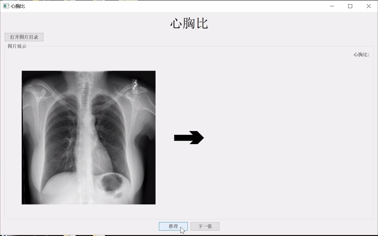 智能自动计算心胸比哔哩哔哩bilibili