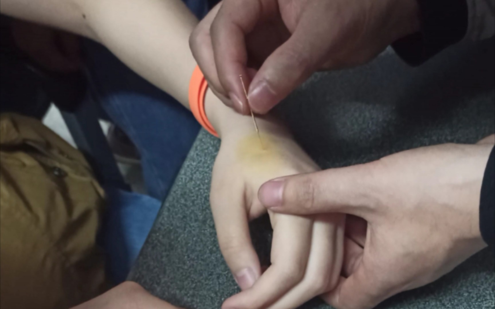 针灸-合谷5,我的内心毫无波澜,甚至想隔天来一下