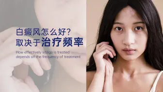 白癜风怎么好？取决于治疗频率