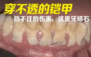 Download Video: 穿不透的铠甲！超厚牙结石清洗过程，治愈哦~