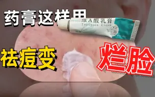 Download Video: 【科普】维A酸乳膏真的那么好用吗？不想烂脸一定要看完！