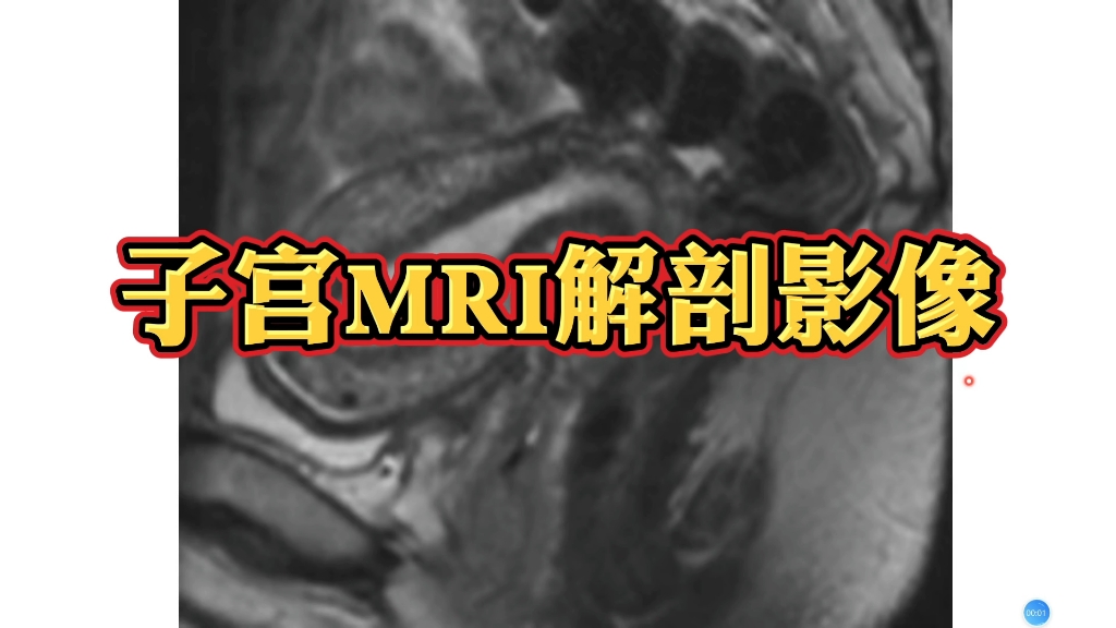 子宫mri影像解剖分享,简单易懂,初学者必看!