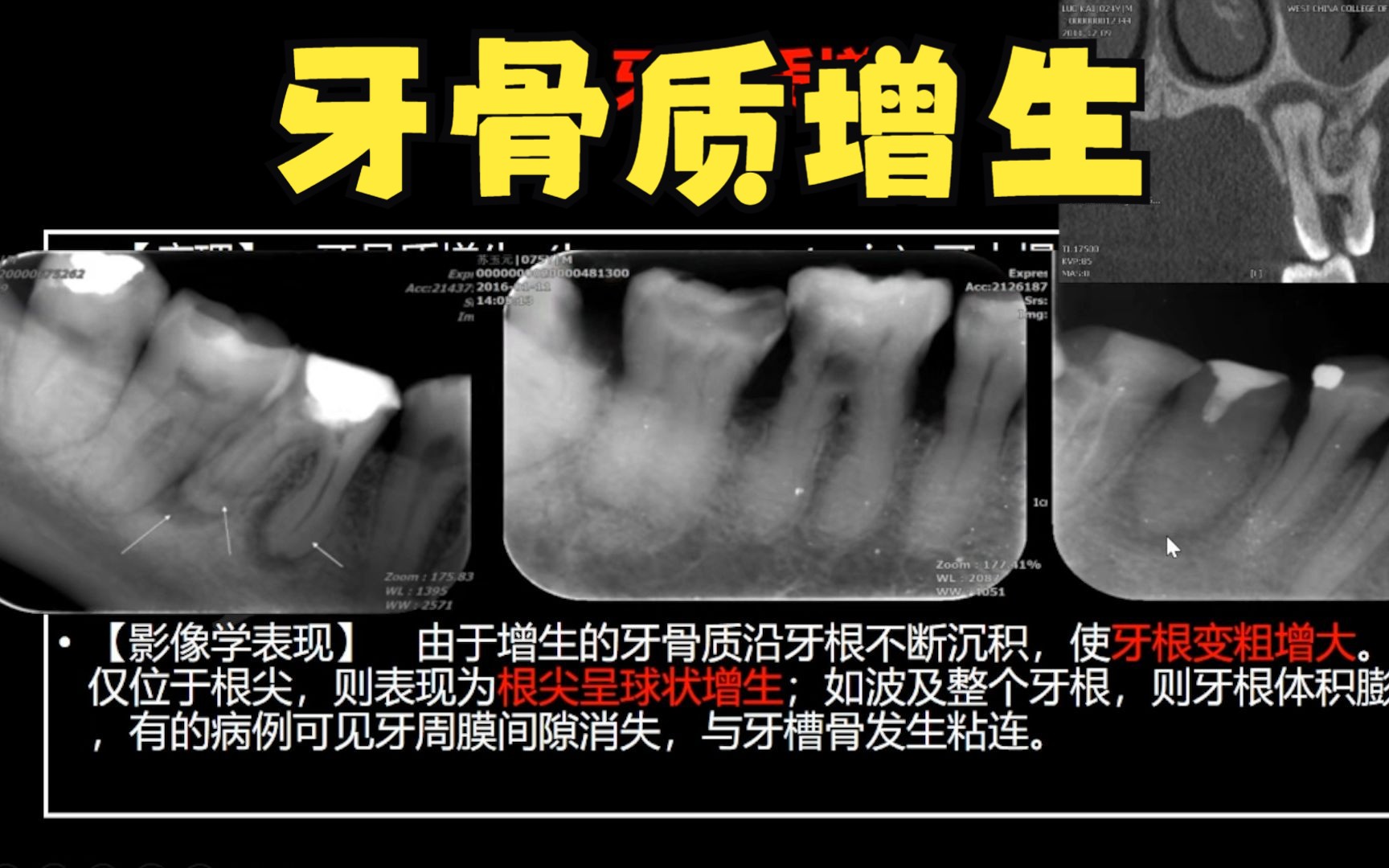 牙医不容易诊断的病症——牙骨质增生