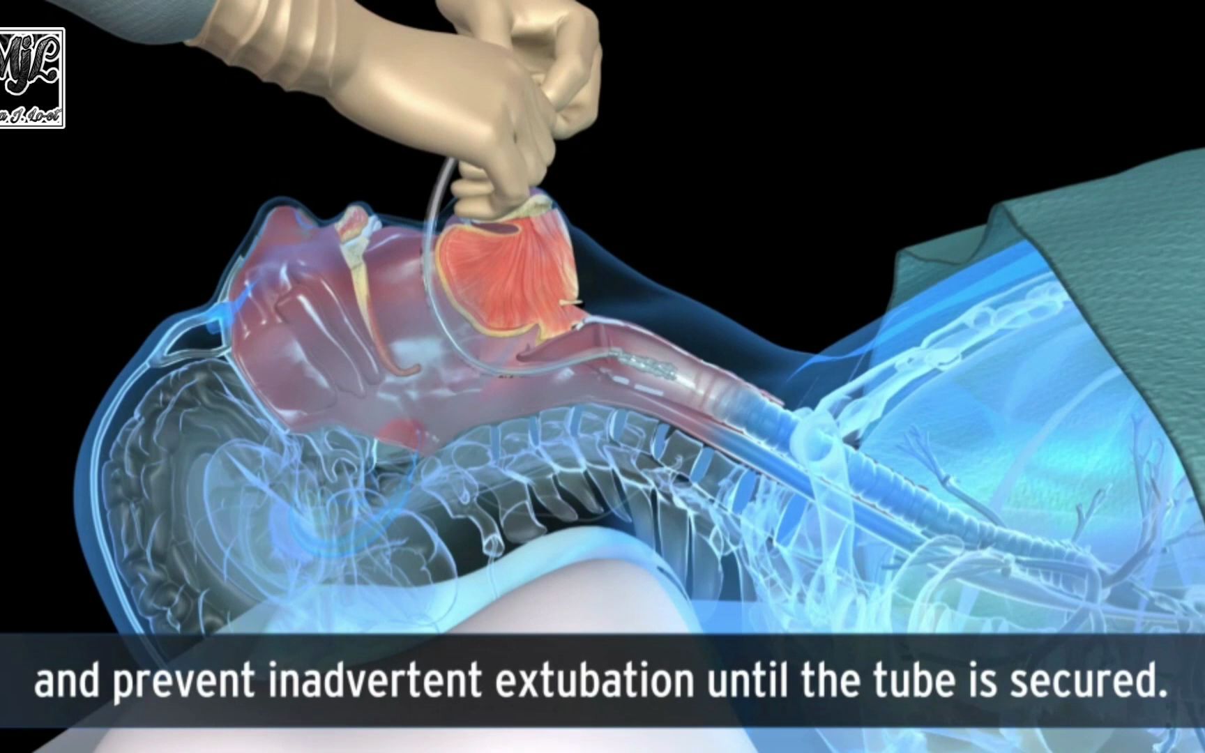 3D医学动画:气管插管技术哔哩哔哩bilibili