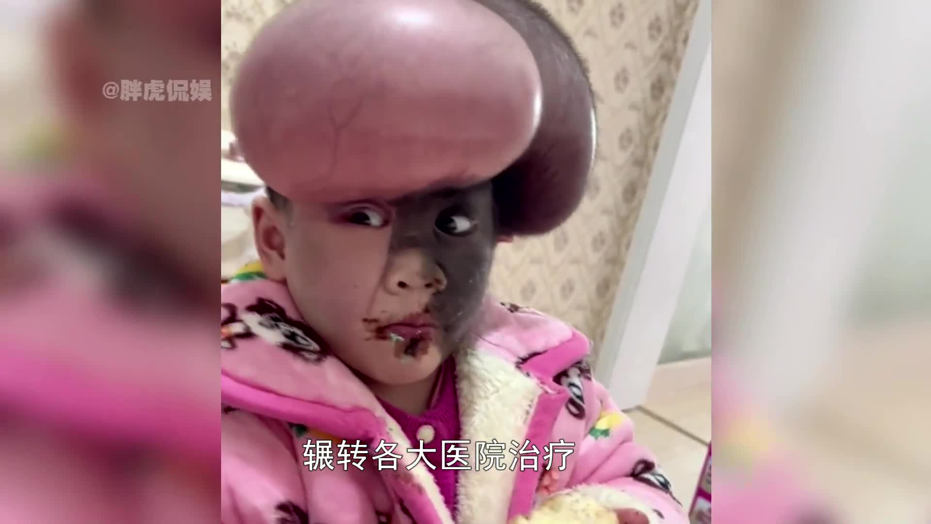 三岁女童患先天兽皮痣,辗转治疗父母被批自私,女儿做法让人泪目
