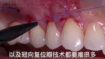 牙龈萎缩—修复牙龈微创隧道手术，看完想立马去医院搞起来