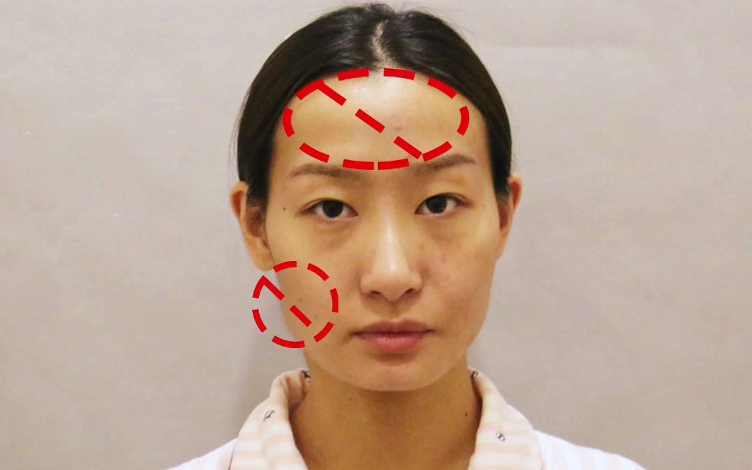 面部扁平凹陷,北京玉之光医院怎么样?