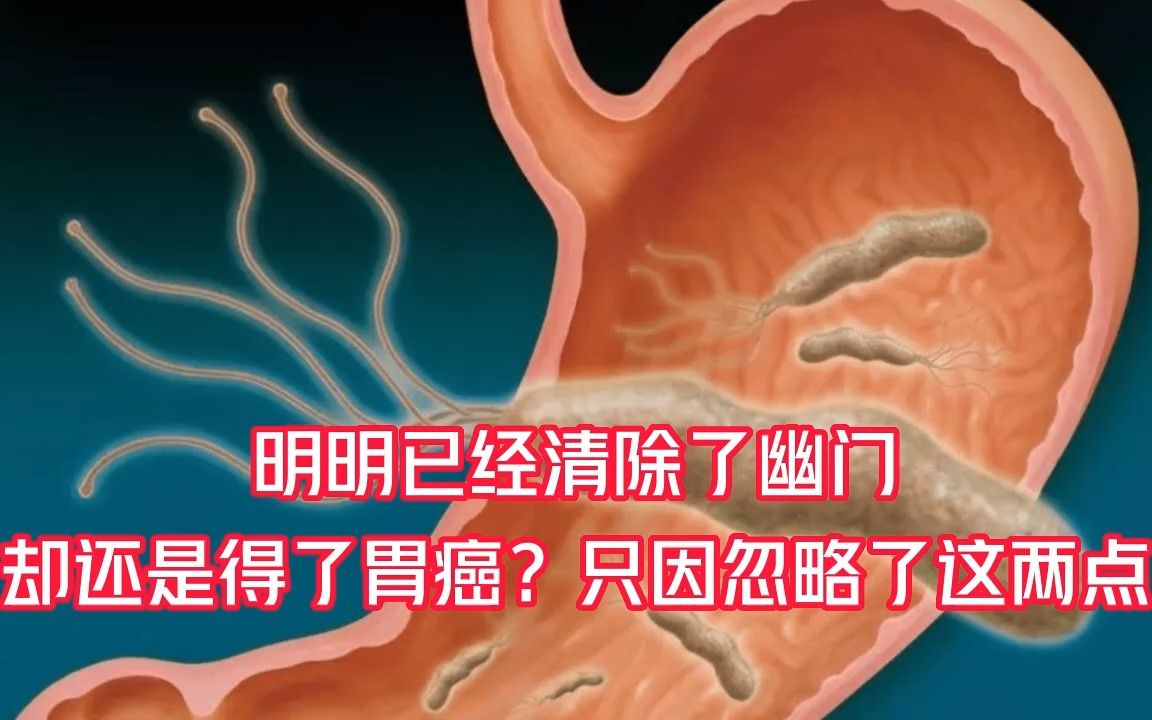 [图]明明已经清除了幽门，却还是得了胃ai，只因忽略了这两点